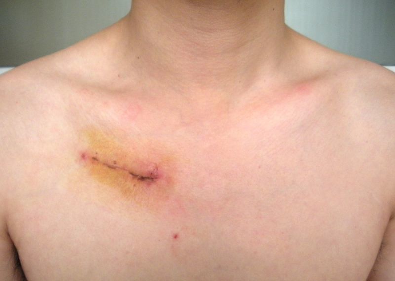 腮腺肿瘤手术疤痕图片图片