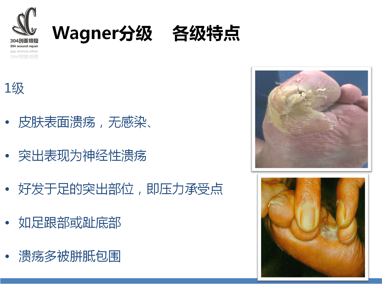 糖尿病足分级以及图片图片