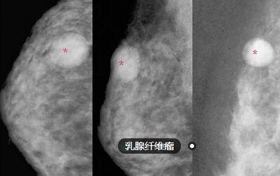 乳腺纤维瘤图片初期图片