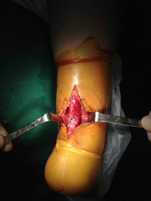 手术专家高绪仁在为踝关节运动损伤跟腱断裂患者进行跟腱断裂修复手术