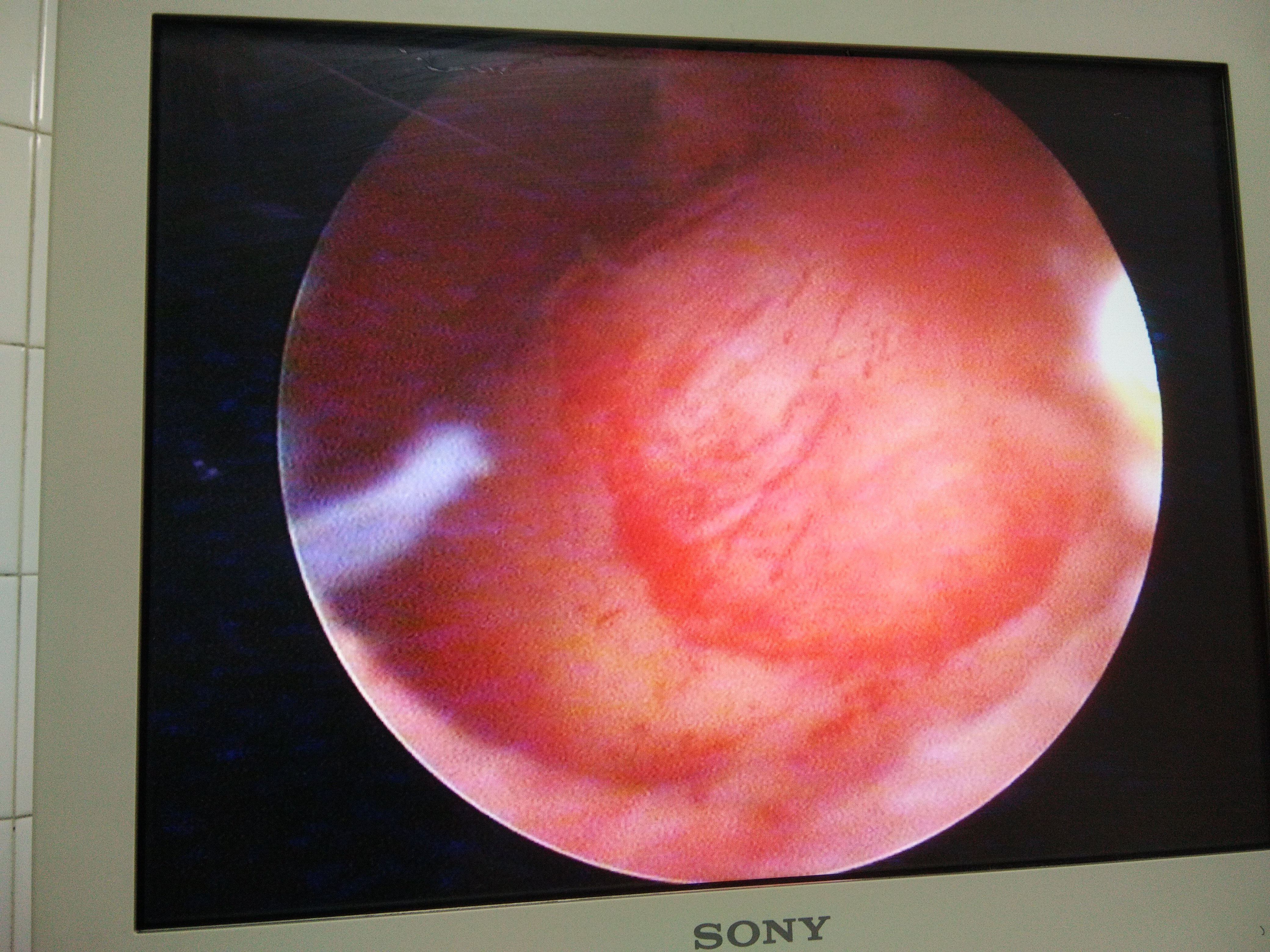 粘膜下子宫肌瘤,直径约4cm,可以做宫腔镜下子宫肌瘤电切 