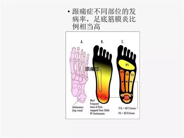 目前对于足底筋膜炎已倾向于弱化其炎症性而强调其在跟骨附丽点的组织