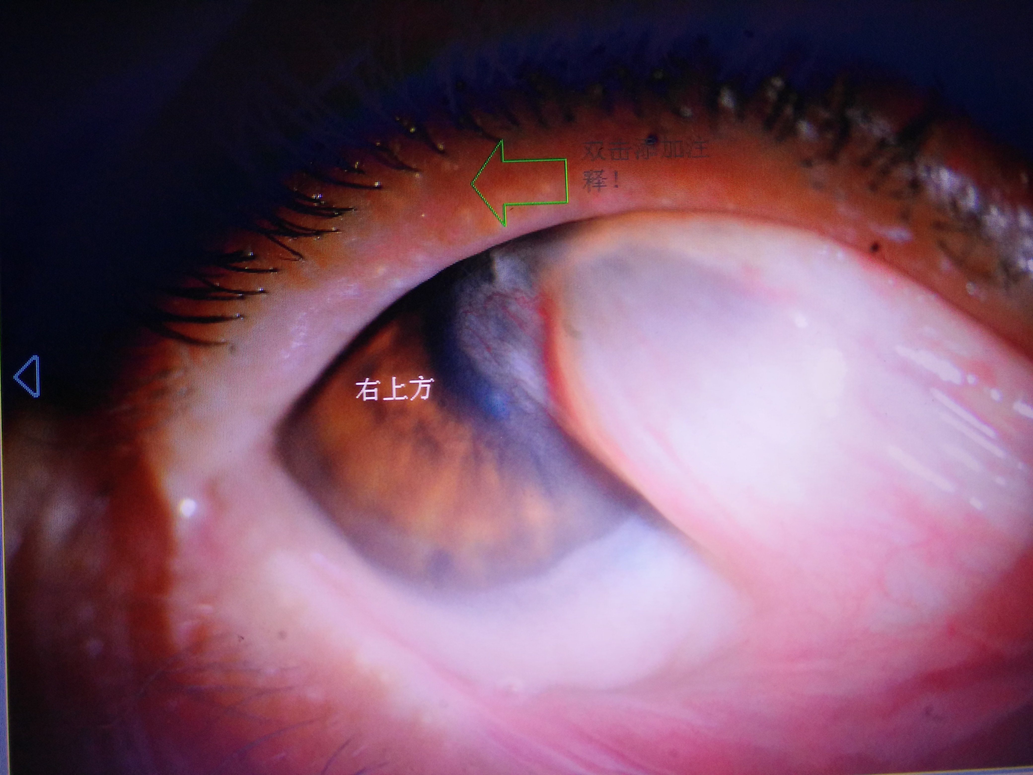 胬肉患者术前眼位训练怎样做?