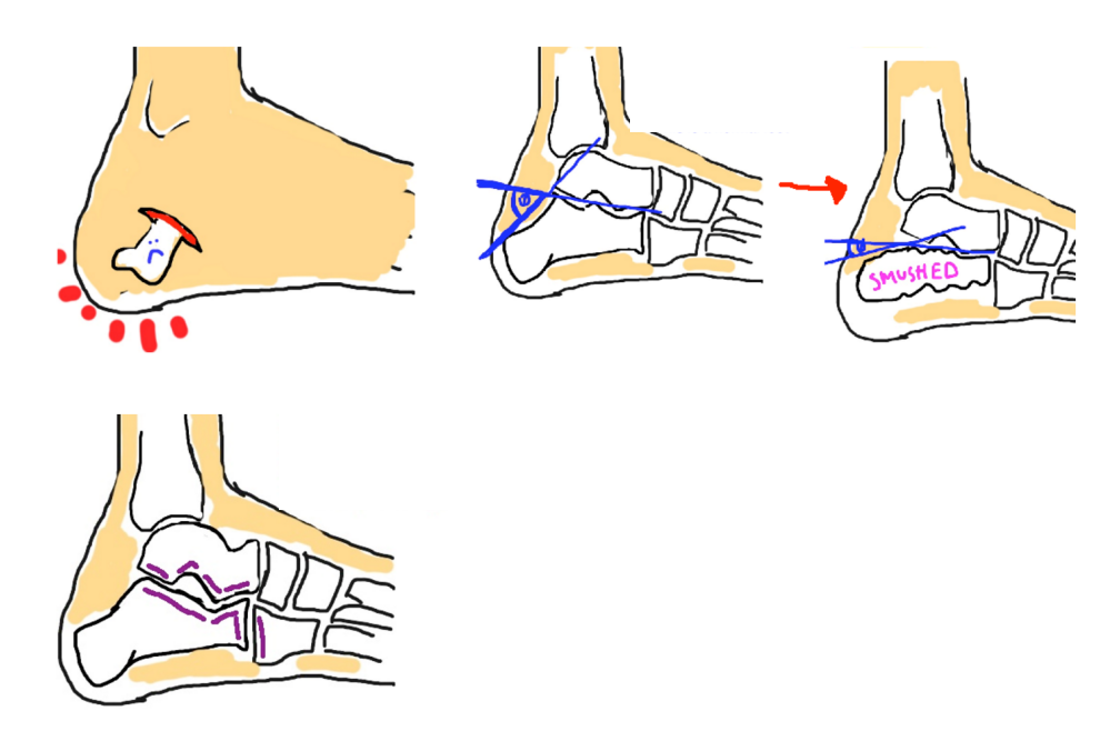 谈谈跟骨骨折那些事儿_跟骨骨折_疾病介绍_治疗方法_介绍_治疗方式