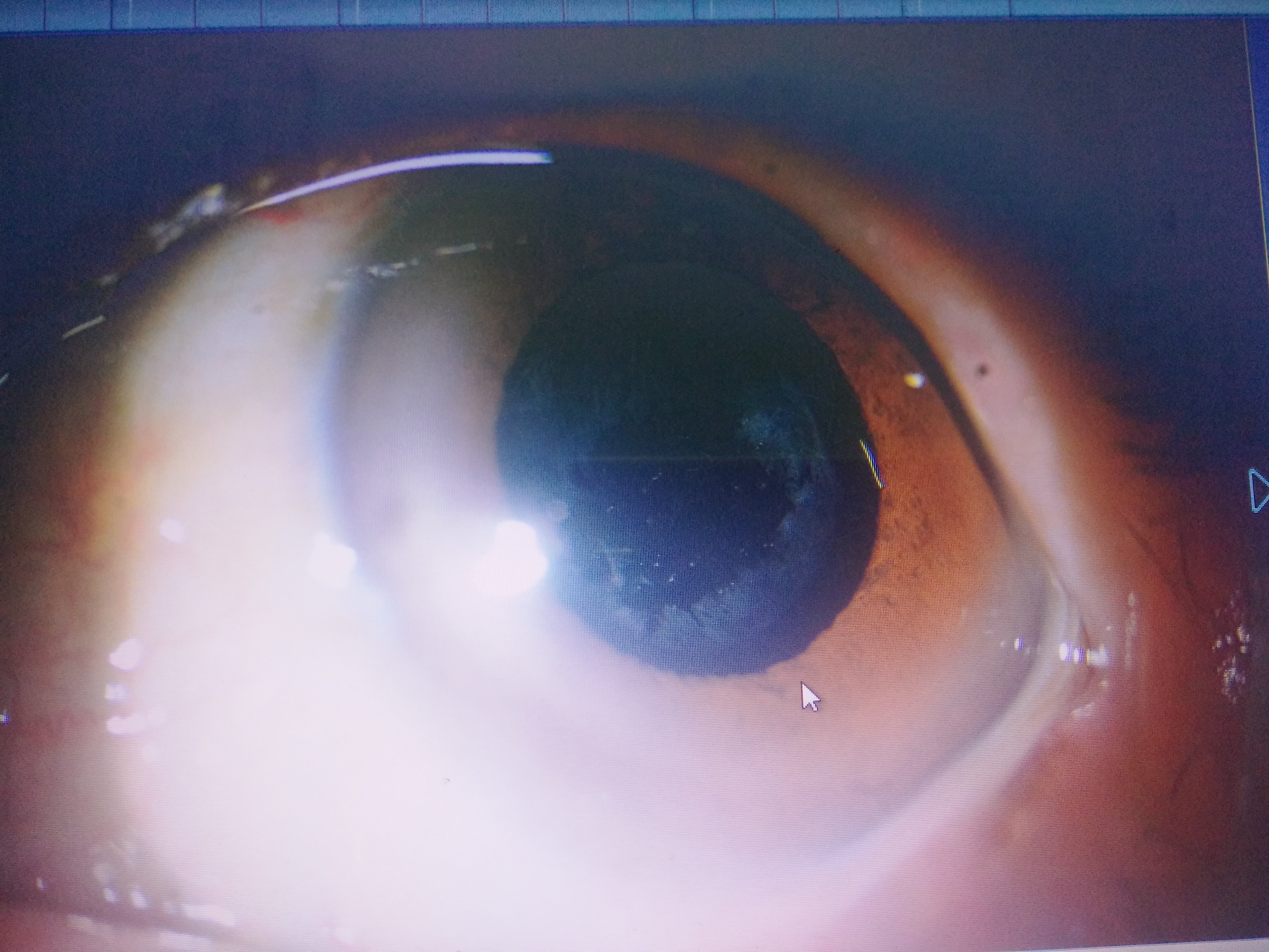 后发障术前(未扩瞳)对于影响视力的后发性白内障,yag激光后囊膜切开术