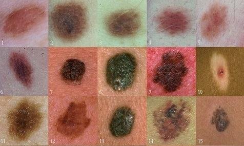 末端的色素痣因为长期摩擦,容易导致恶变;长在甲下的色素痣(甲母痣)