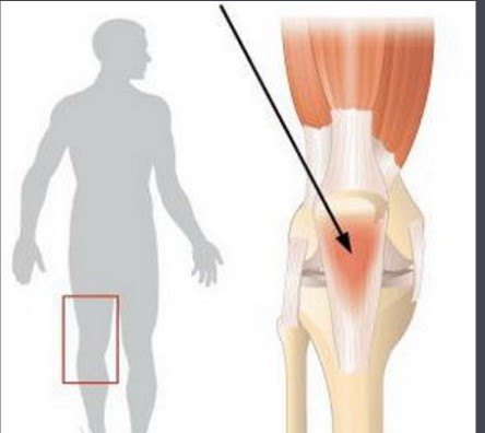 肌腱炎 病 弹跳膝 髌腱炎 该如何治疗