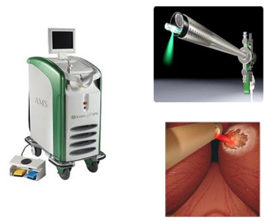 6,绿激光前列腺汽化术治疗效果