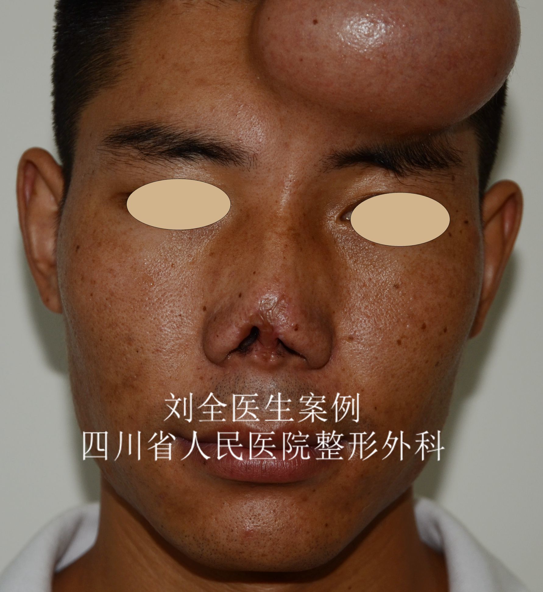 鼻再造 - 好大夫在线