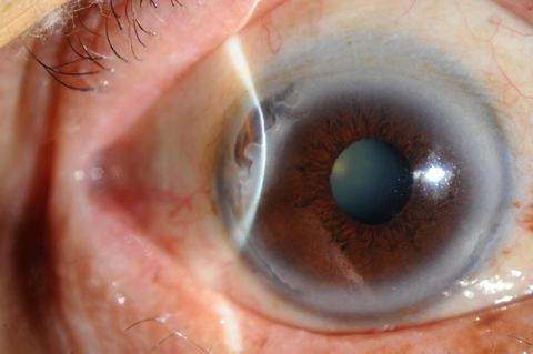 边缘性角膜变性 (原创)