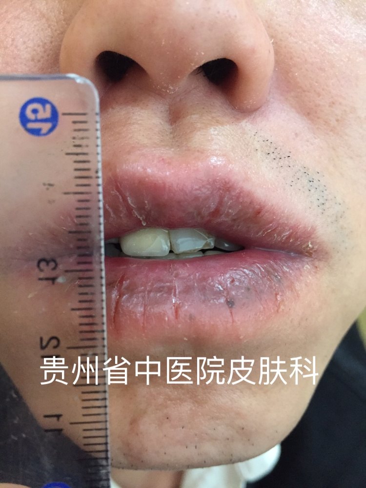 剥脱性唇炎