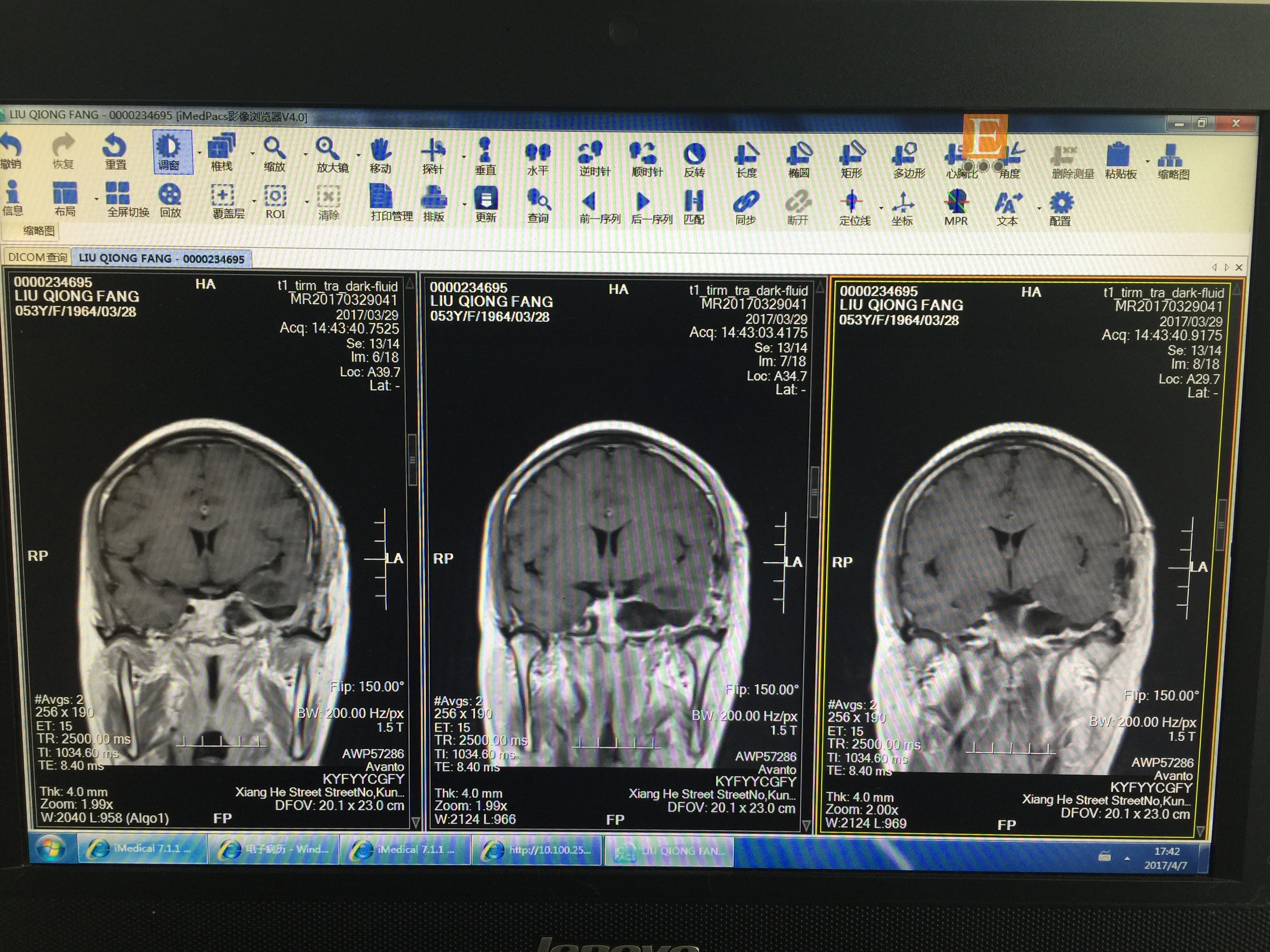 三叉神经瘤图片