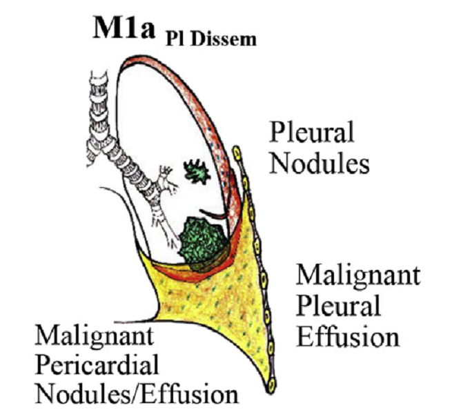 iaslc第八版肺癌tnm分期图示Ⅳab