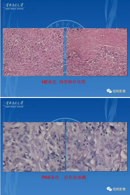 肺肉芽腫病變的影像表現和病理基礎