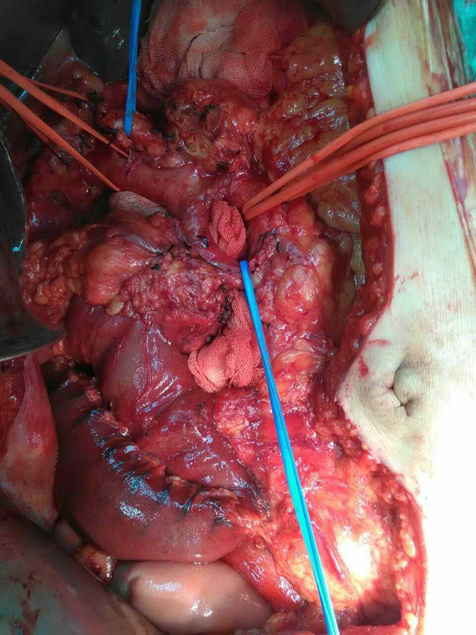 胰头癌手术图片