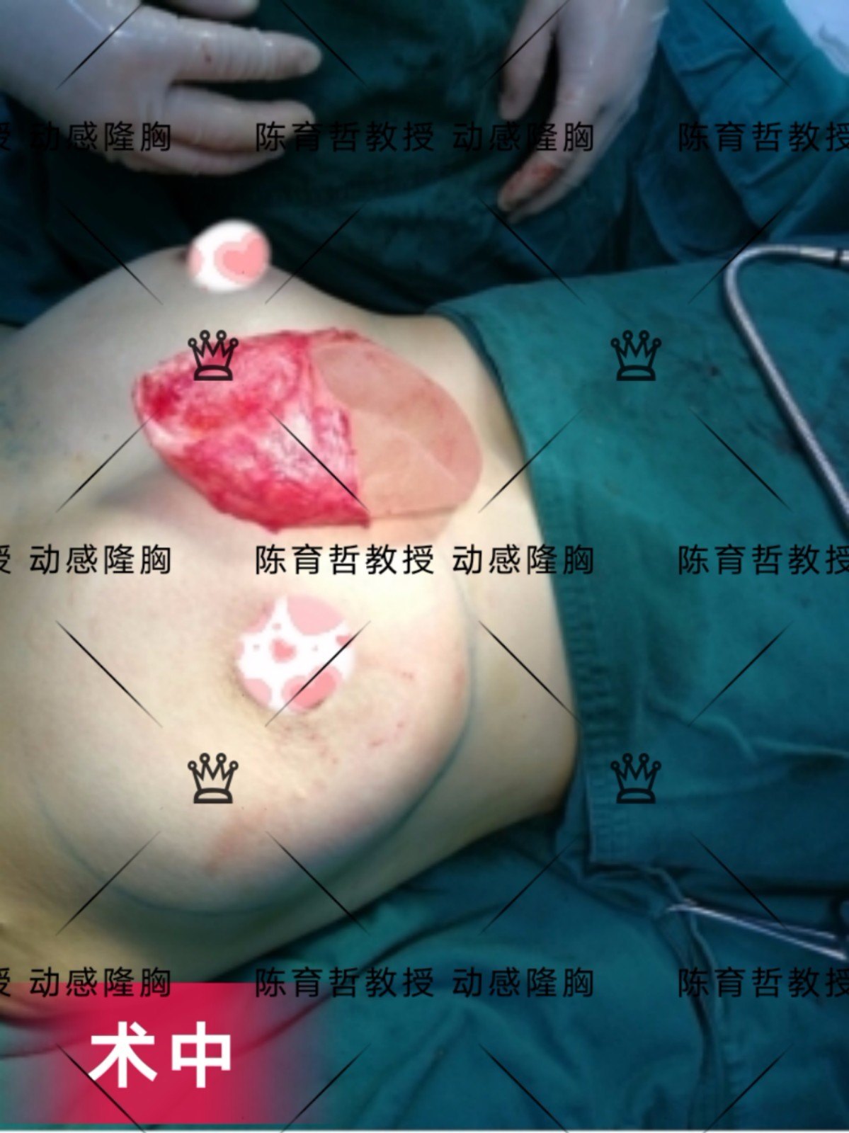 缩胸手术案例图图片