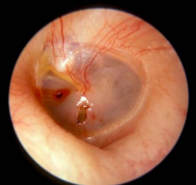 鼓膜穿孔要不要马上手术修补 鼓膜穿孔 手术 鼓膜穿孔要不要马上手术修补 鼓膜穿孔 手术