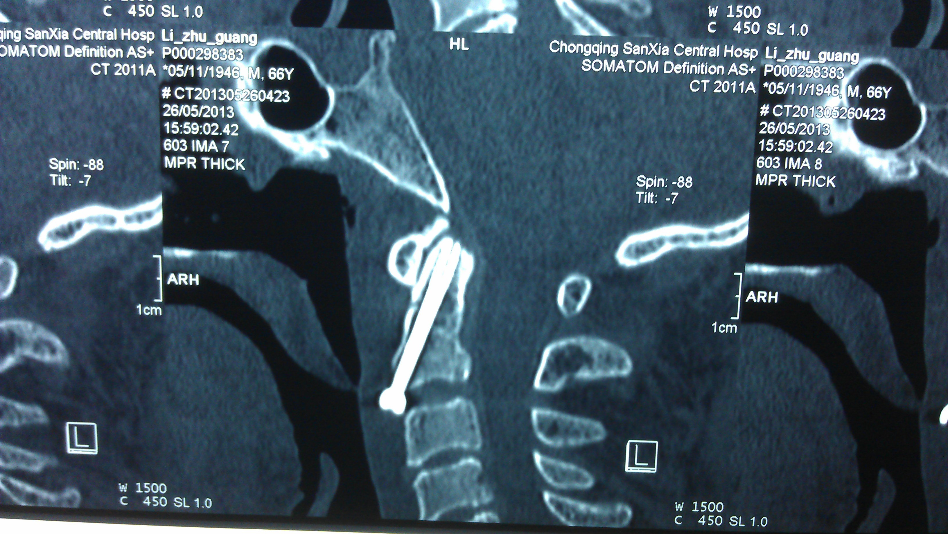 高危颈椎骨折枢椎齿状突骨折