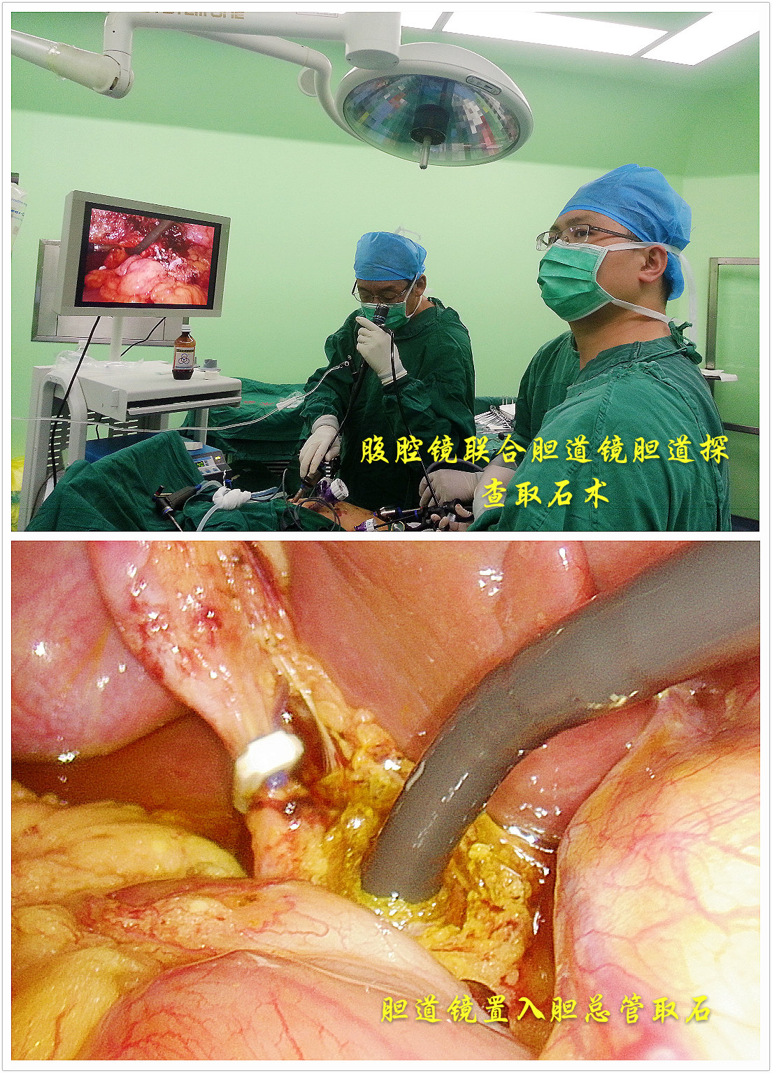 (4)胆道镜技术:术中与腹腔镜联合应用治疗胆管结石,术后通过t管窦道取