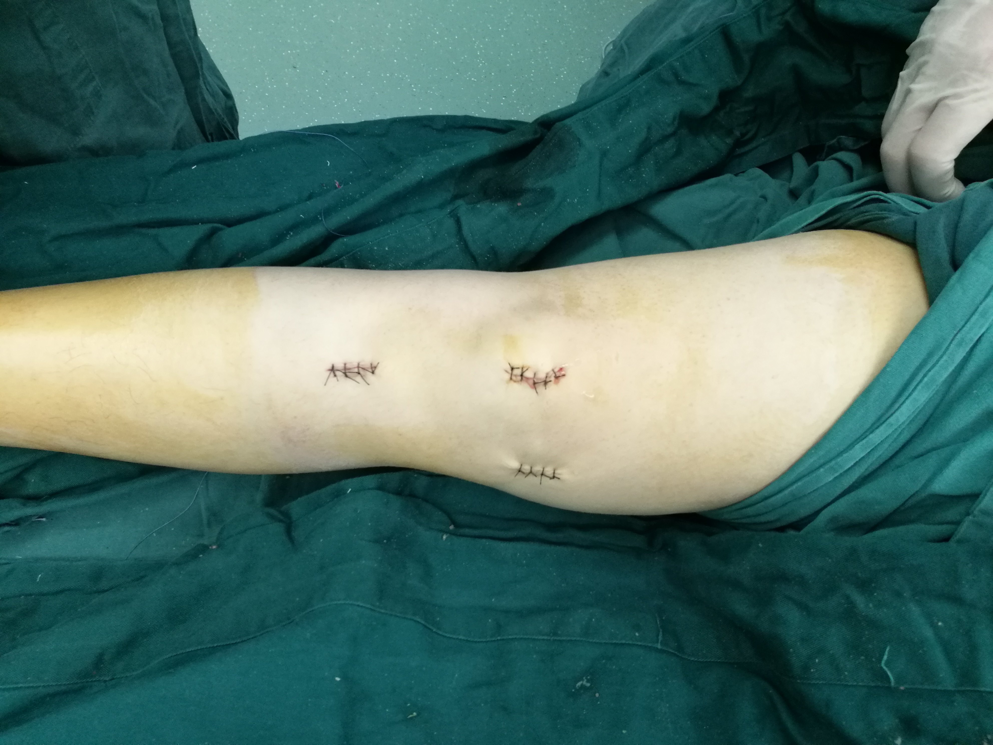 膝关节髌股韧带损伤,复发性髌骨脱位 