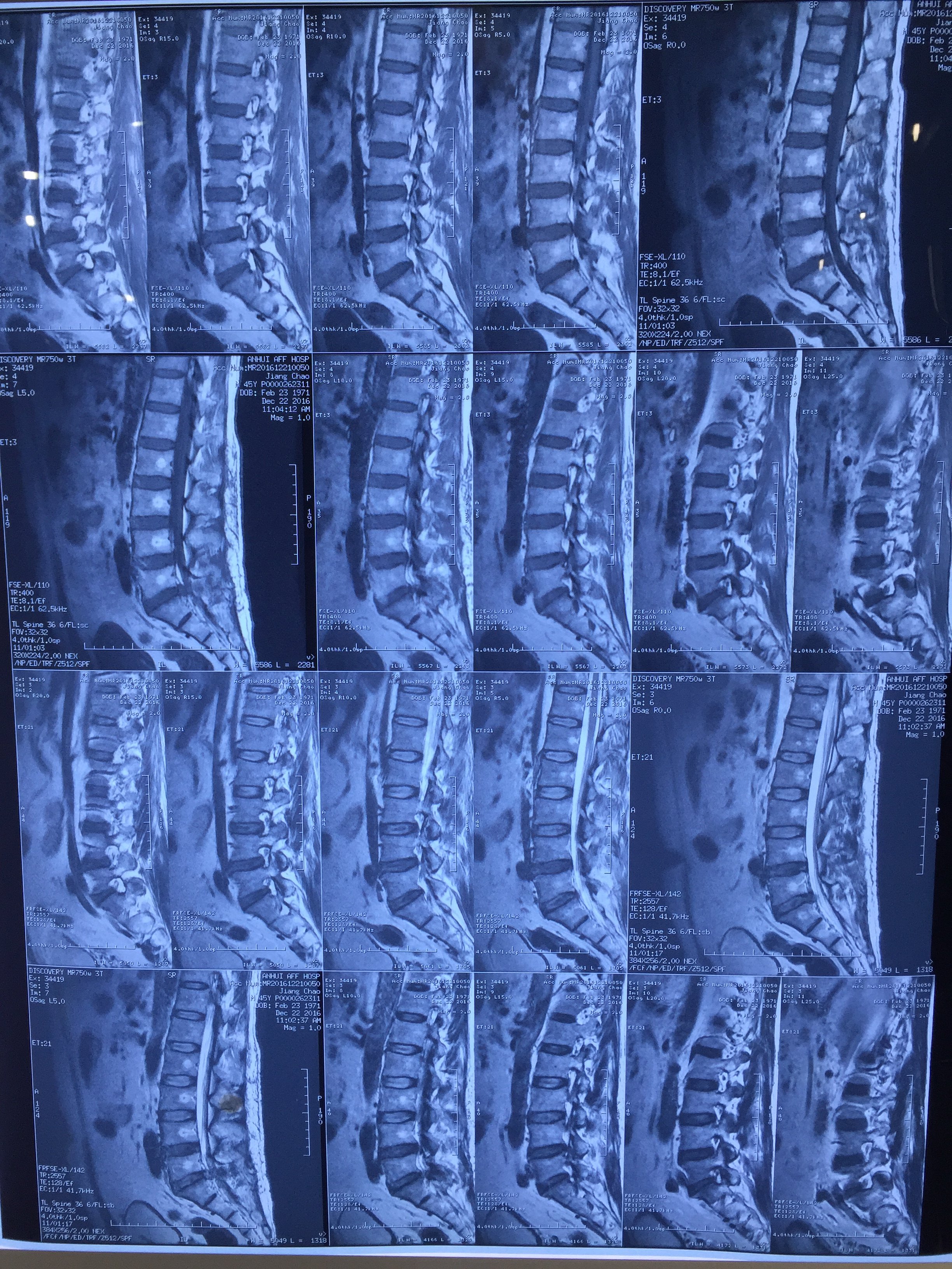 腰5骶1椎間盤突出