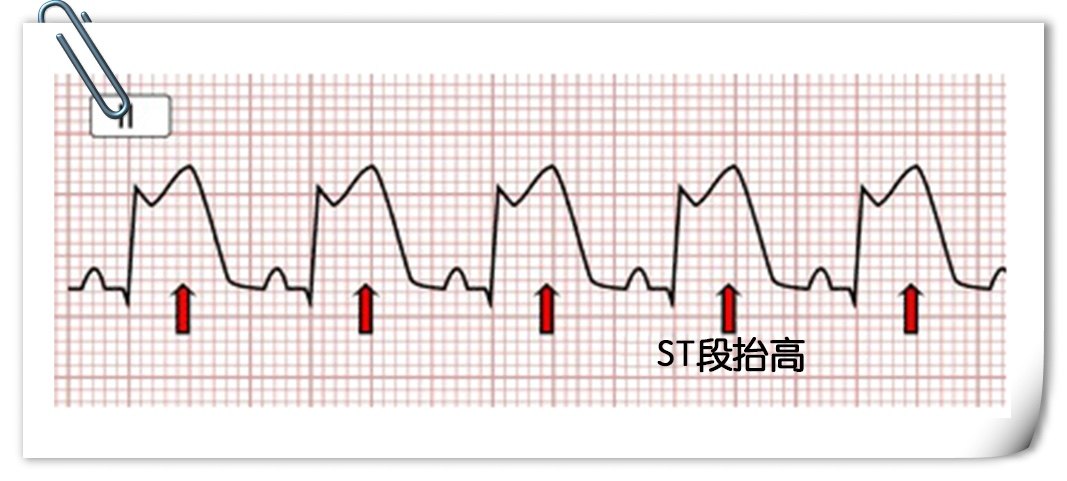 st段弓背向上抬高图片图片