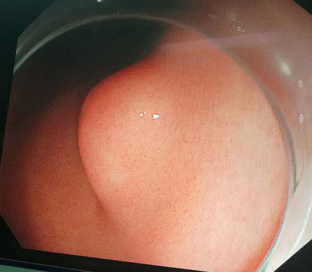 患者,男,45岁,因体检发现胃底肿物,超声胃镜显示考虑胃间质瘤可能性大