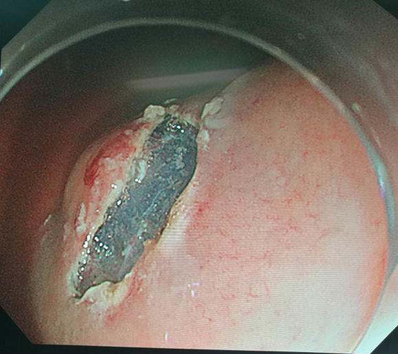 胃镜下胃间质瘤切除术 