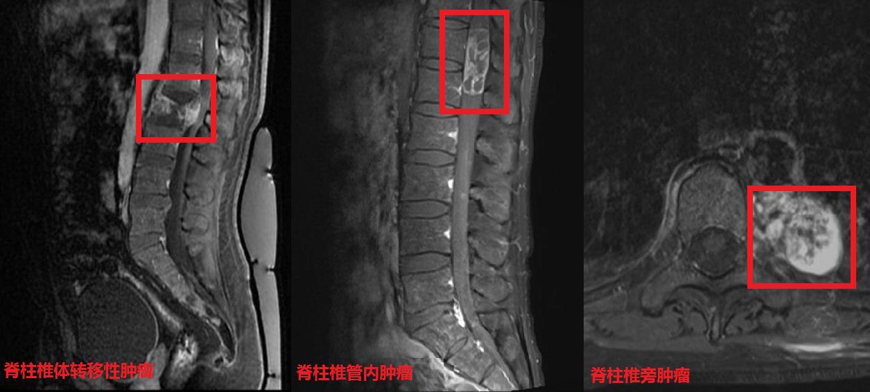 如果病人体检偶然发现的脊柱良性肿瘤,这类疾病往往没有症状,对脊柱