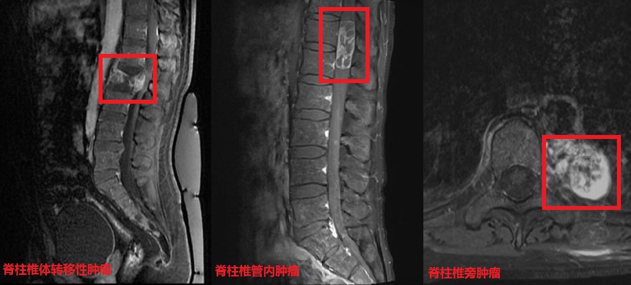 脊柱肿瘤相关知识问答 复旦大学附属肿瘤医院神经外科 好大夫