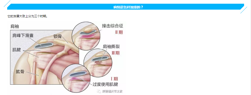 肌腱炎病肩峰撞擊不明原因肩膀痛可能是你太愛乾淨