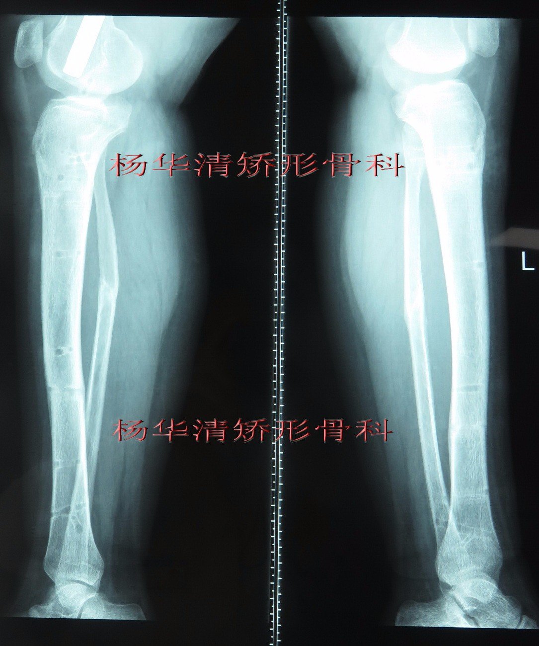 o型腿o形腿重度膝内翻病例杨华清矫形骨科