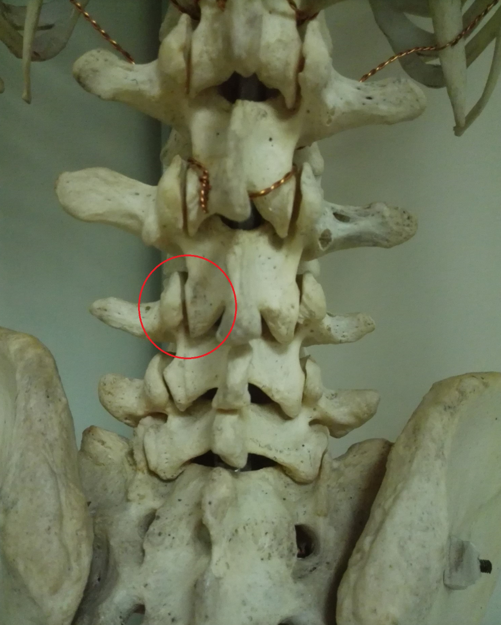 上图中黄医生画圈的部位就是典型的腰椎关节突关节