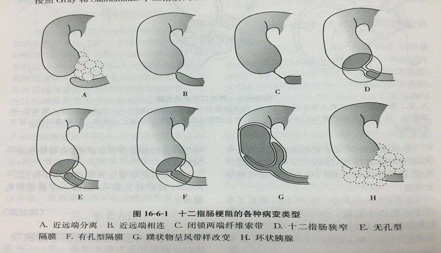 十二指腸梗阻是如何診斷的