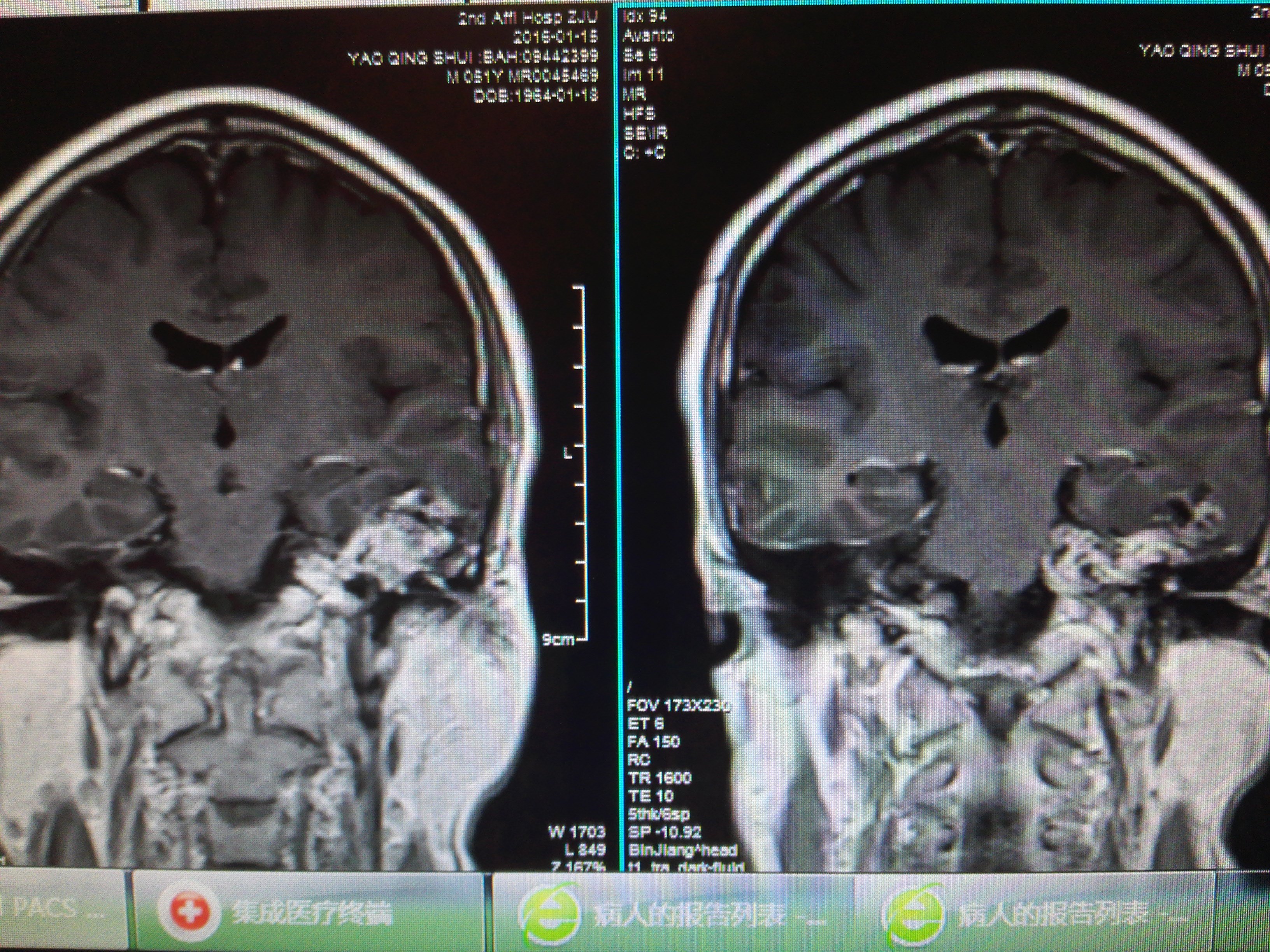 巨大骑跨中后颅窝哑铃型神经鞘瘤全切治疗 - 好大夫在线