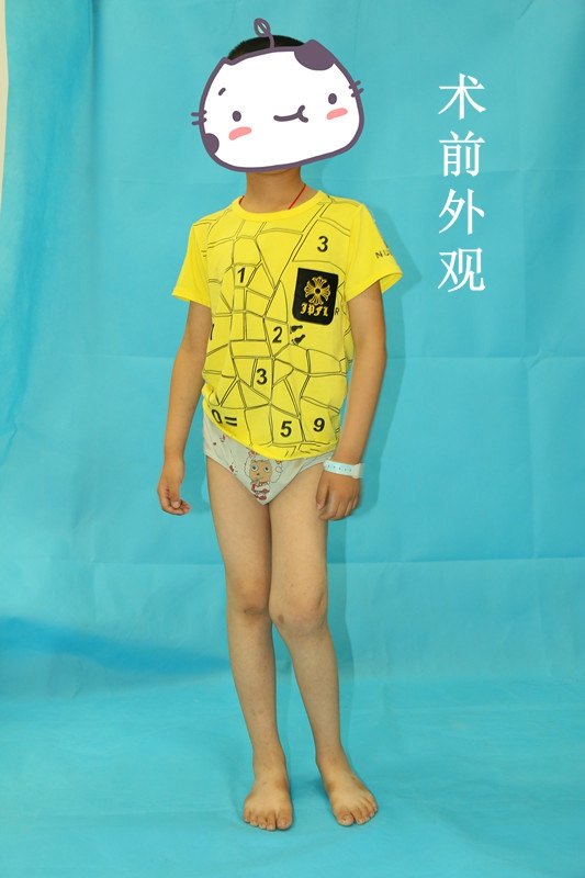 先天性髌骨脱位多在10岁后发病,女性多于男性,没有明显的外伤史,膝
