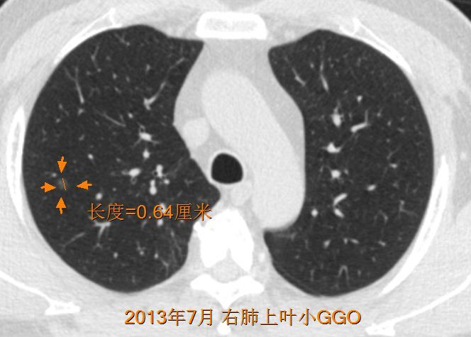 肺磨玻璃結節的生長速度如何會不會突然變成晚期肺癌