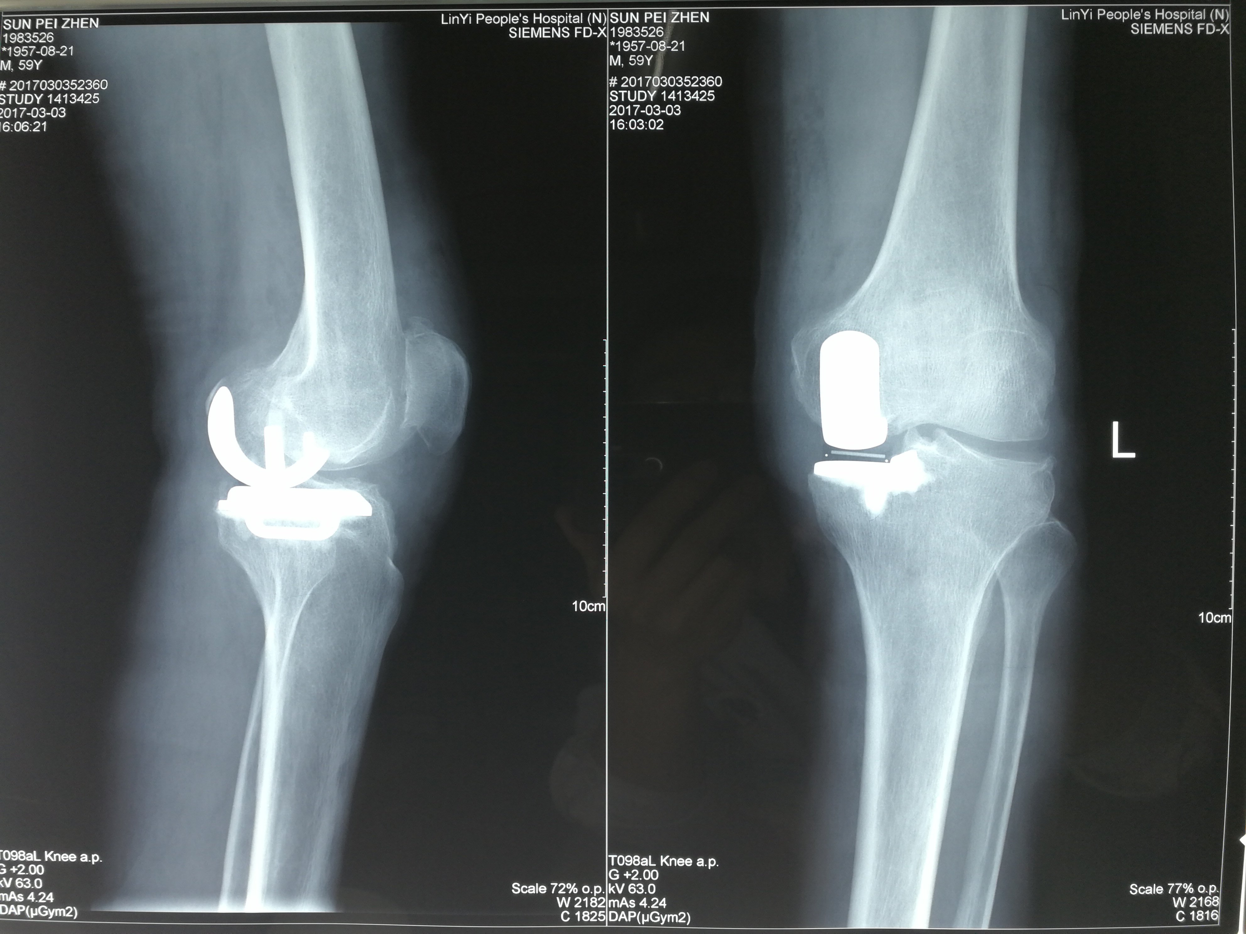 膝关节骨性关节炎患者的福音