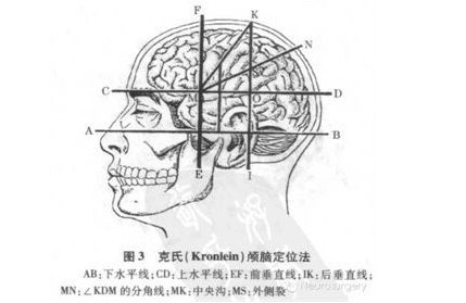颅骨重要骨性标志及颅内结构的体表投影