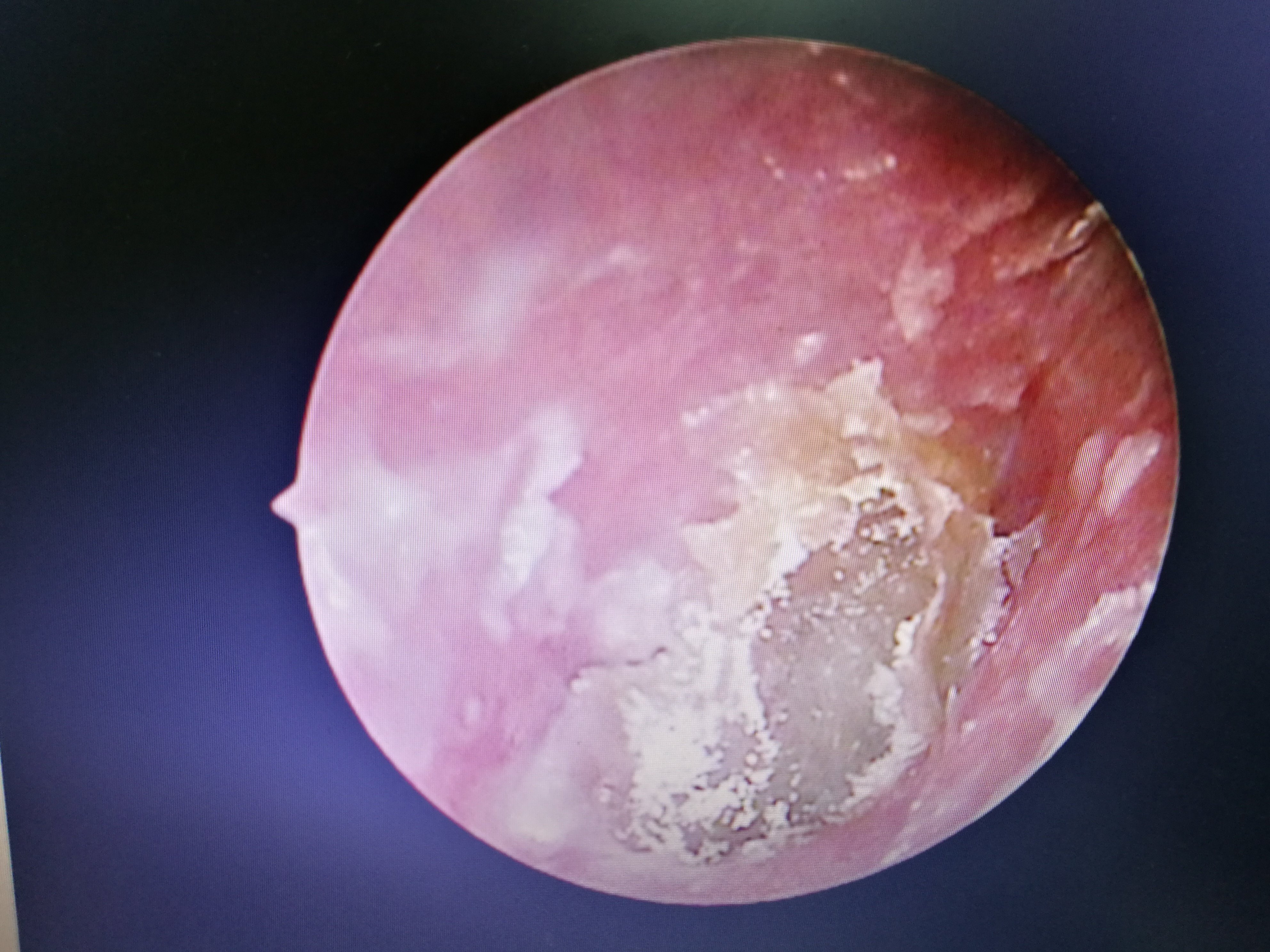 见耳道潮湿及黑褐色真菌生长正常鼓膜真菌性外耳道炎是引起耳痒最常见