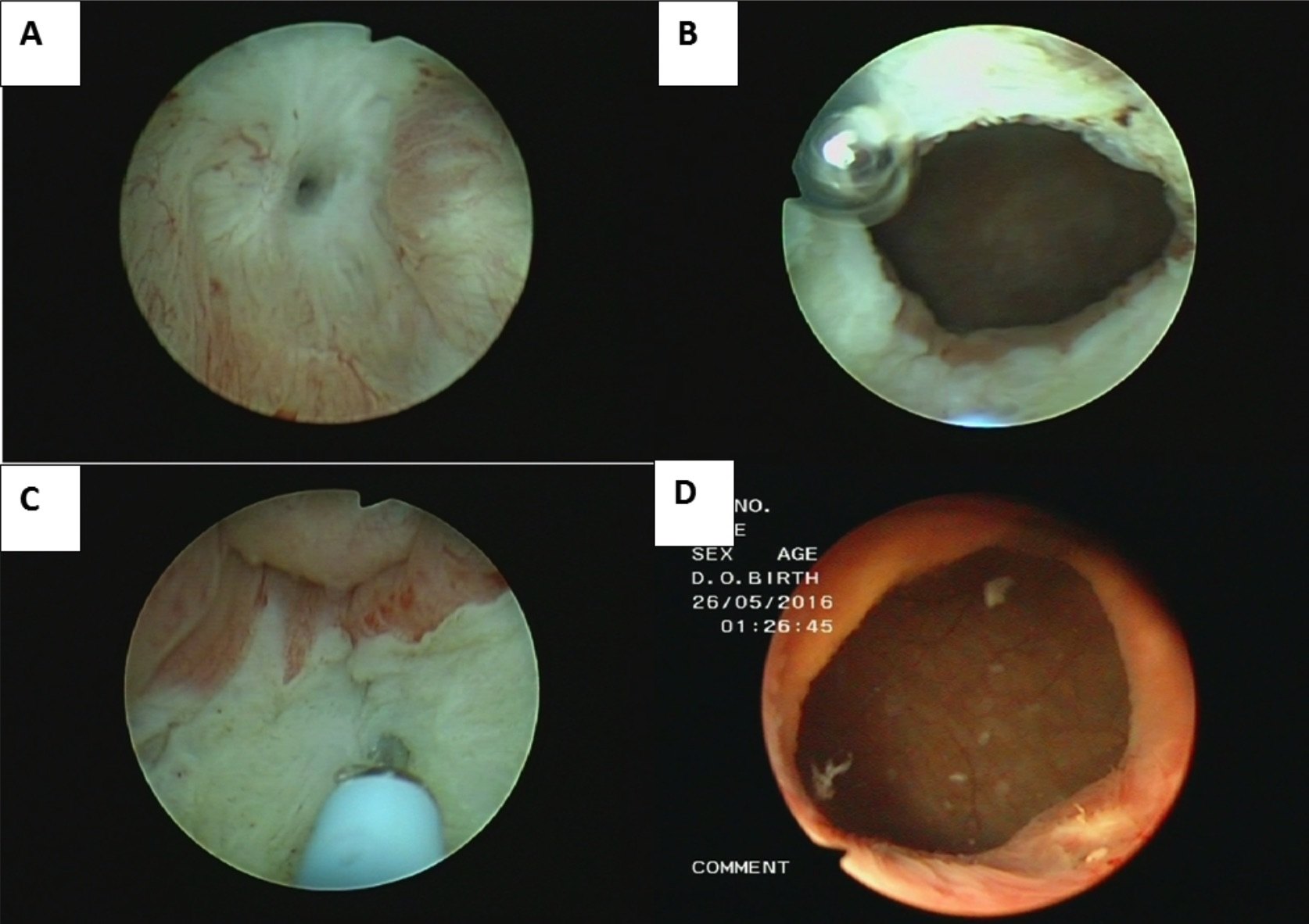 前列腺电切术后膀胱颈挛缩的治疗新方式