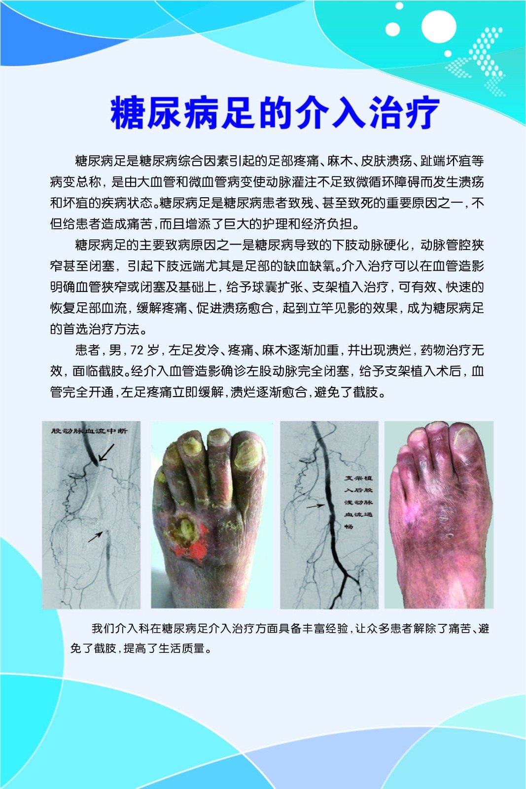 糖尿病足介入治疗 - 好大夫在线