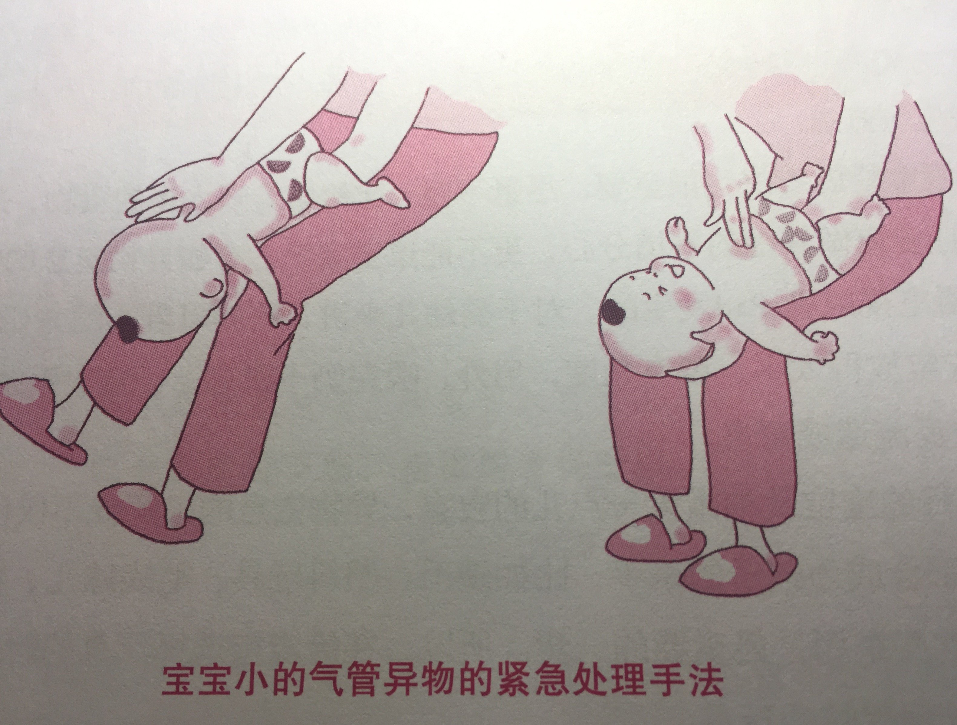 婴幼儿气管异物