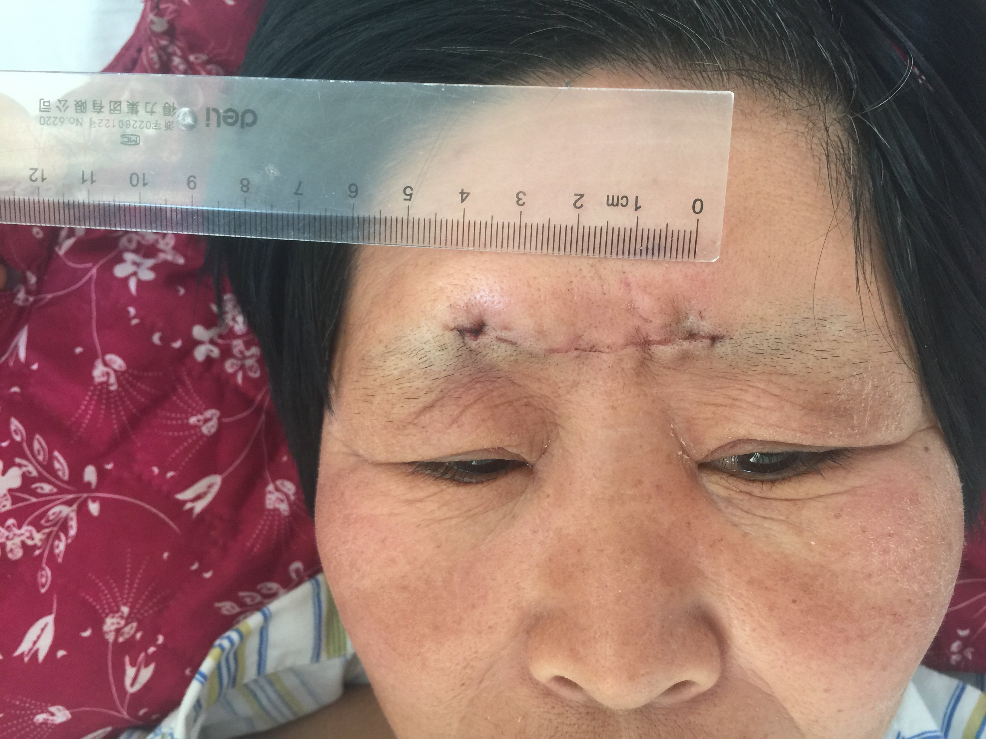 眉间锁孔切除大型垂体囊肿-窦以河-青大附院