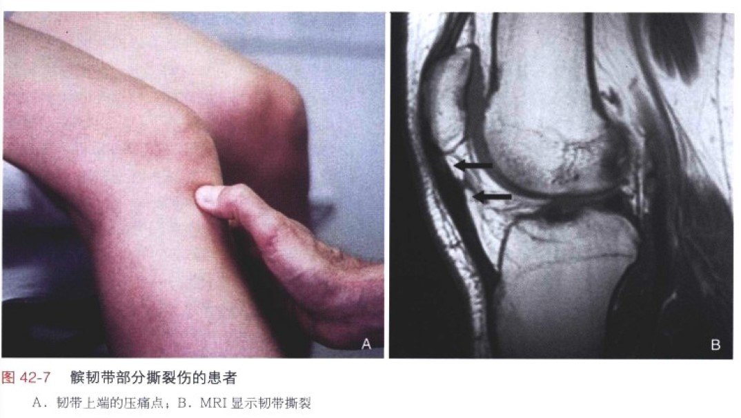 肌腱炎病弹跳膝髌腱炎该如何治疗