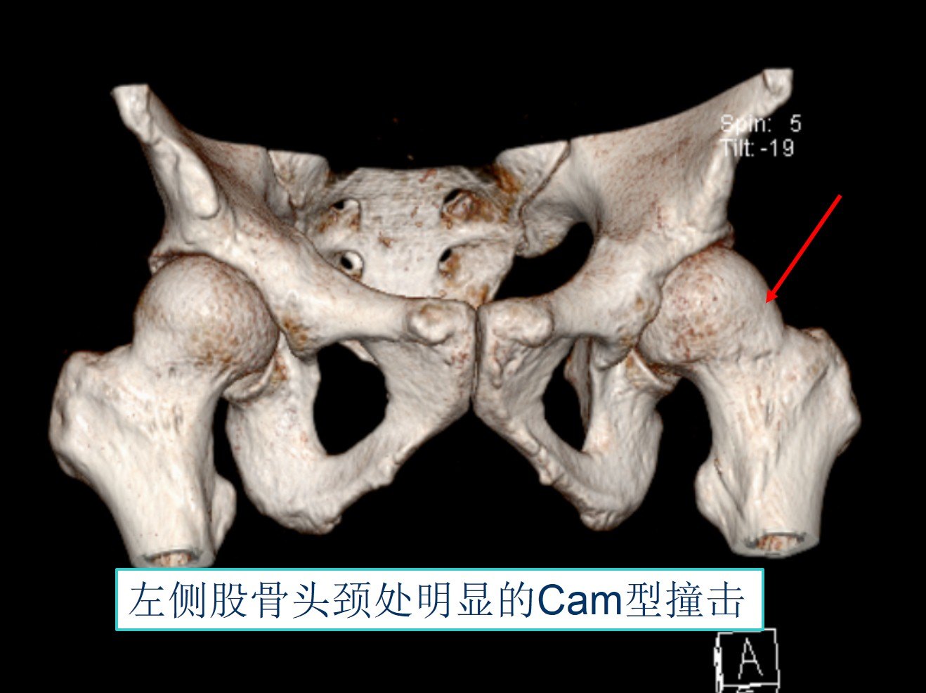 髋关节镜技术髋关节撞击综合征fai的治疗