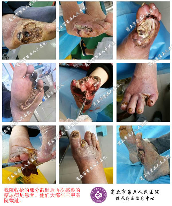 治疗糖尿病足的方法哪个好?