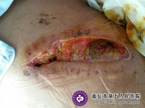 难愈合创面:手术后刀口不愈合导致难愈合创面