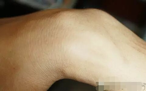 手腕骨膜炎的症状图片图片