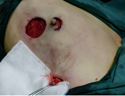 乳腺导管瘤的真人图片图片